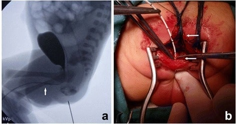 Imperforate anus with rectopenile fistula surgery