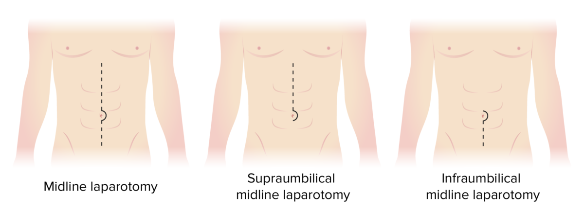 Incision sites for types of midline laparotomies