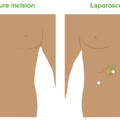 Incisions for open and laparoscopic cholecystectomy