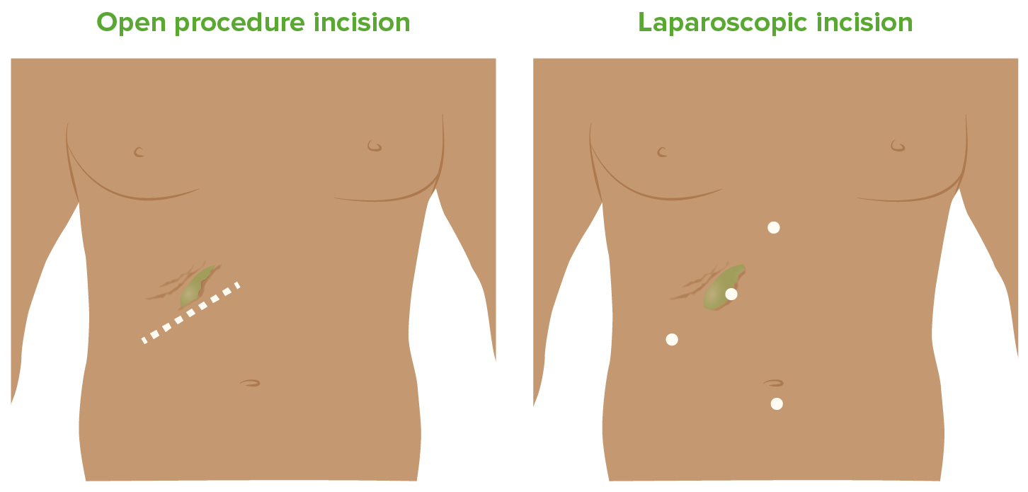 Incisions for open and laparoscopic cholecystectomy