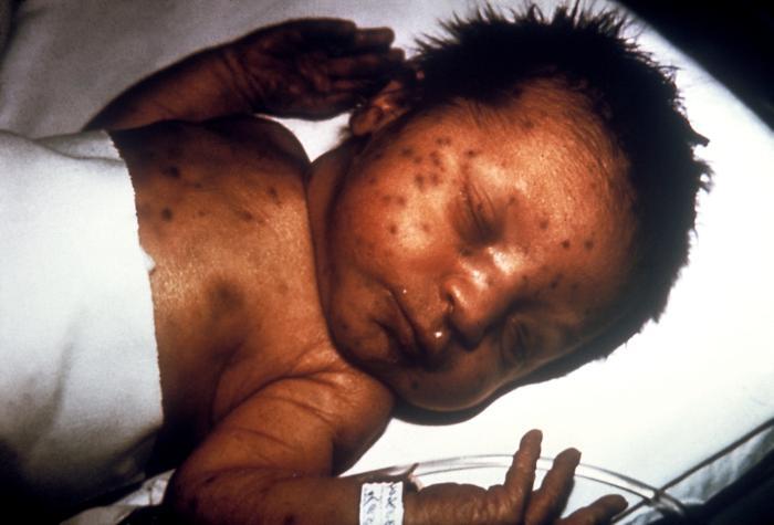 Infant with blueberry muffin rash rubella virus
