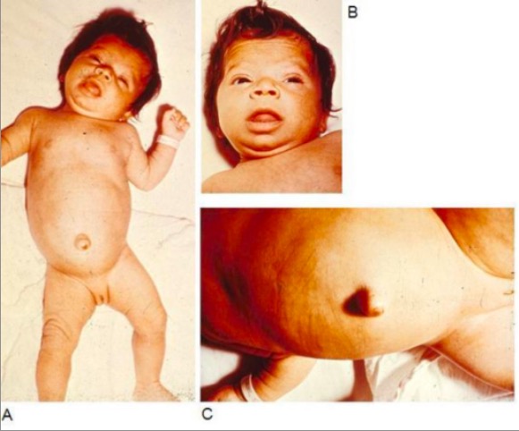 Bebé com hipotiroidismo congénito