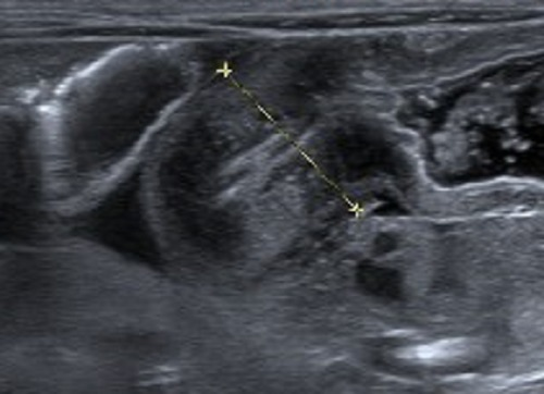 pyloric stenosis ultrasound protocol