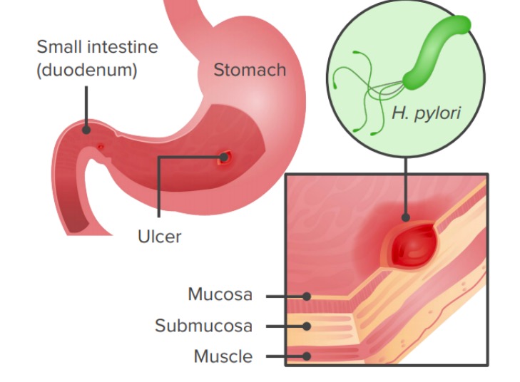 Infection with helicobacter pylori