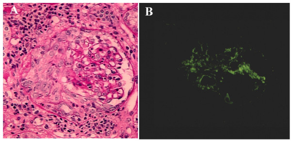 Infective endocarditis-induced rapidly progressive glomerulonephritis