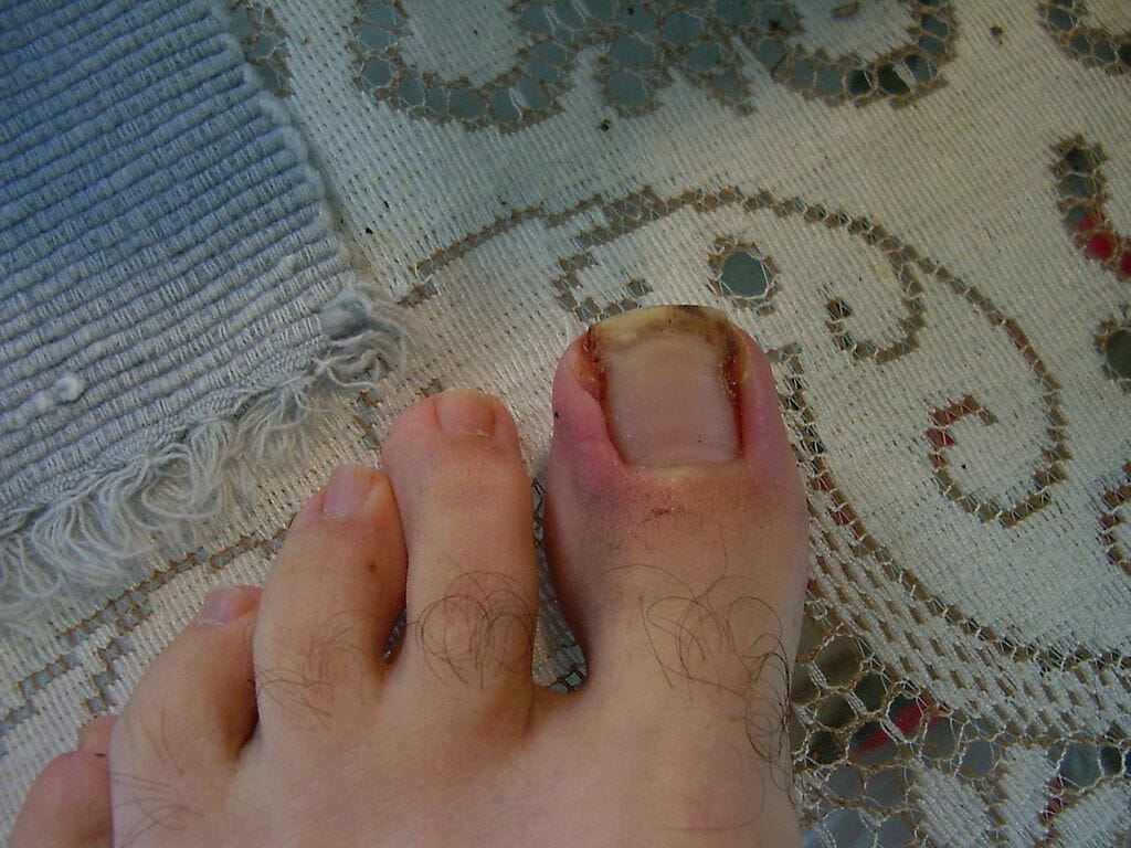 Ingrown toenail of the 1st digit