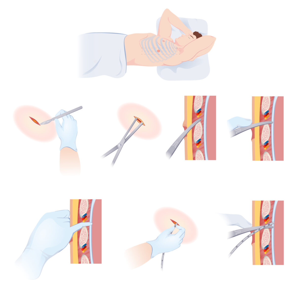 Insertion of a chest tube - thoracostomy
