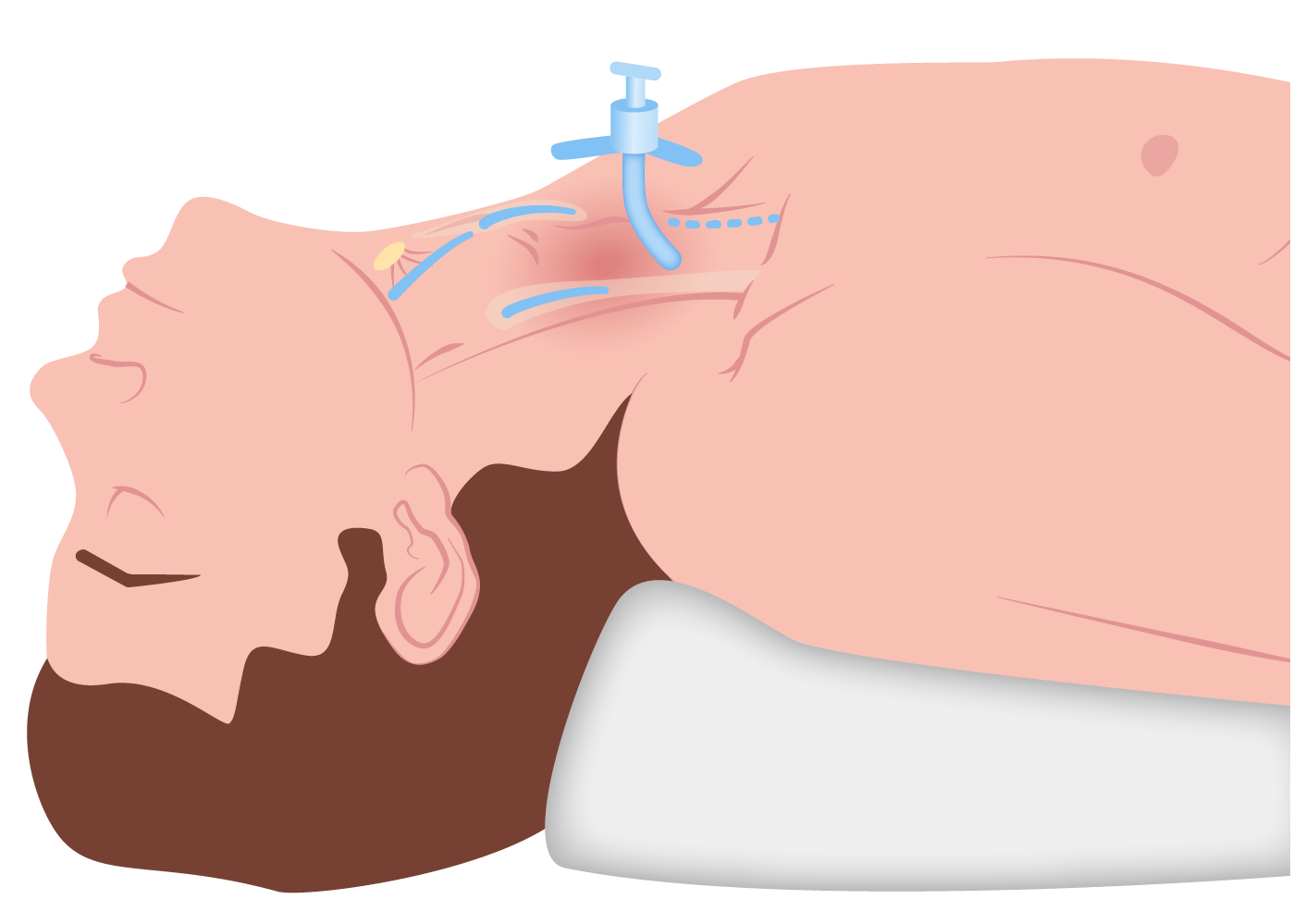 Staphylococcus  Concise Medical Knowledge