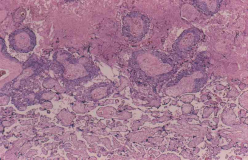 Interface entre coriocarcinoma com necrose central e placenta normal