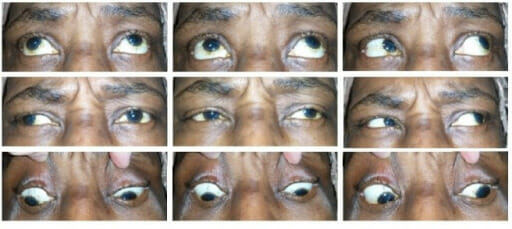 Internuclear ophthalmoplegia secondary to cocaine abuse
