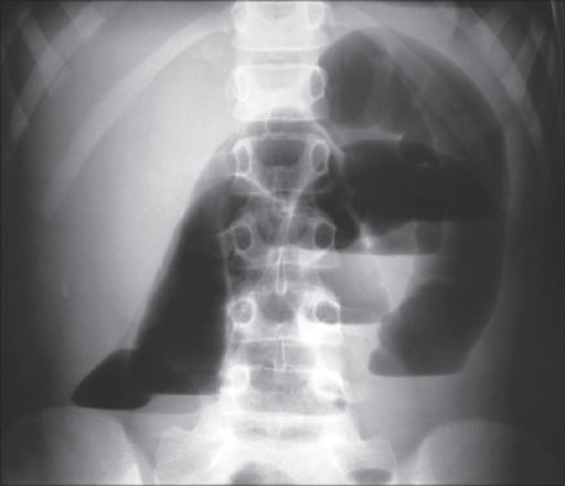 Intestinal obstruction due to an anomalous congenital band