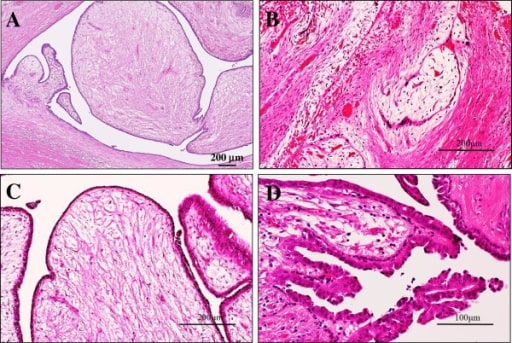 Benign Breast Conditions - Gynecology - Medbullets Step 2/3