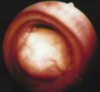 Intraluminal tracheal tumor causing severe airway obstruction