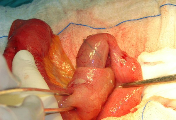 Intraoperative image of an ileoileal intussusception