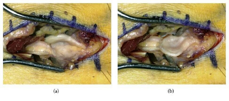 Intraoperative photographs showing a morton neuroma