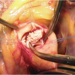 Intraoperative vegetation findings on the aortic valve