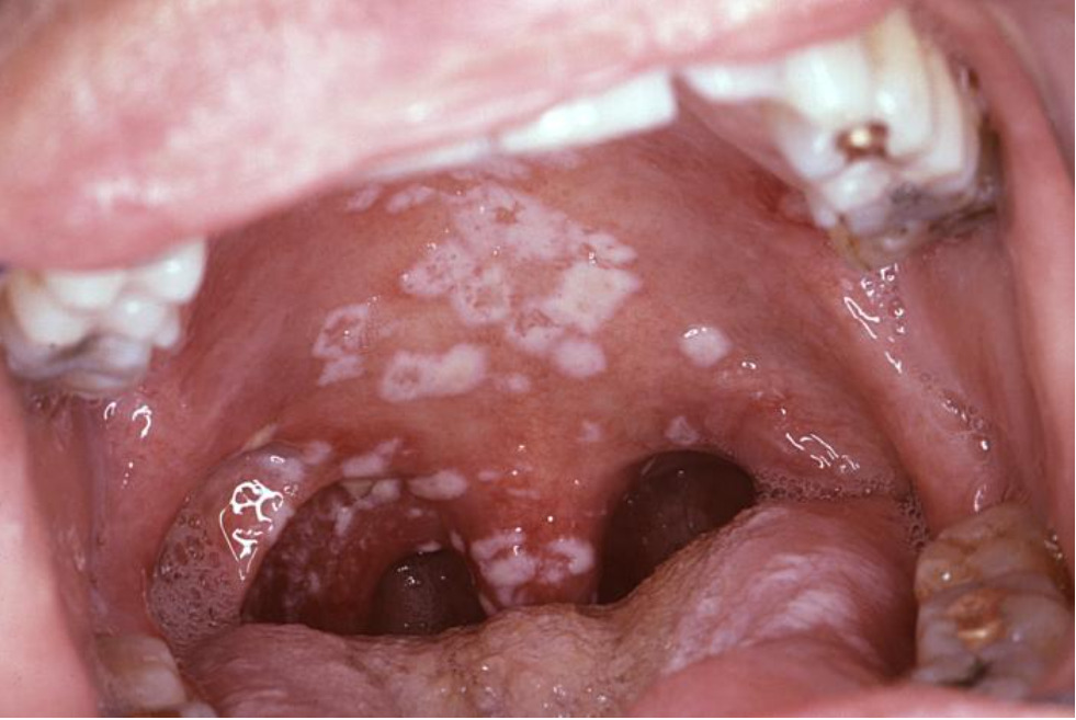 Intraoral view of an individual with aids with secondary oropharyngeal candidiasis infection