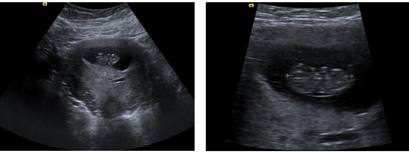 Intrauterine pregnancy within a gestational sac