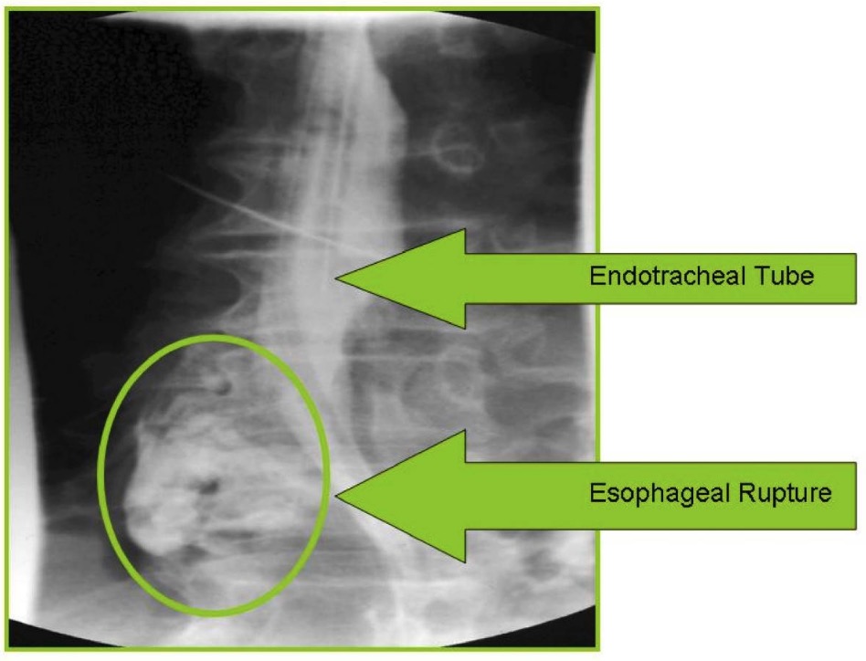 Intubated patient showing esophageal rupture during gastrografin swallow