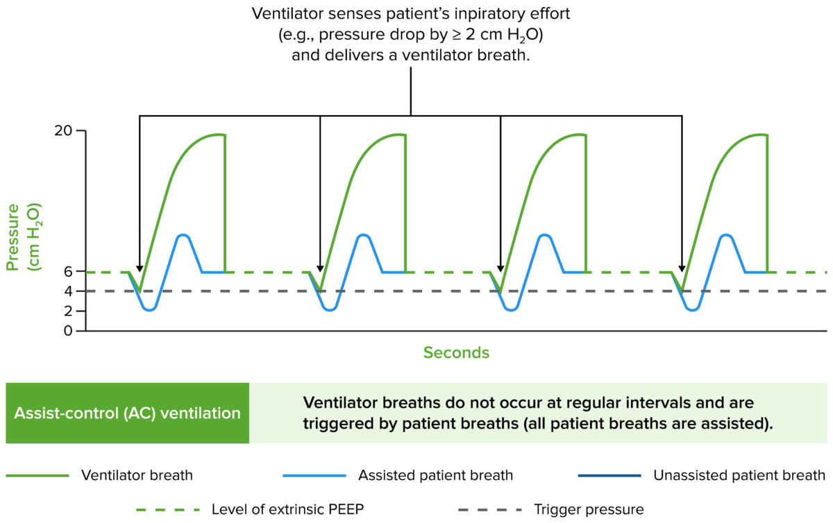 Trazados de presión de las vías respiratorias en los principales modos de ventilación