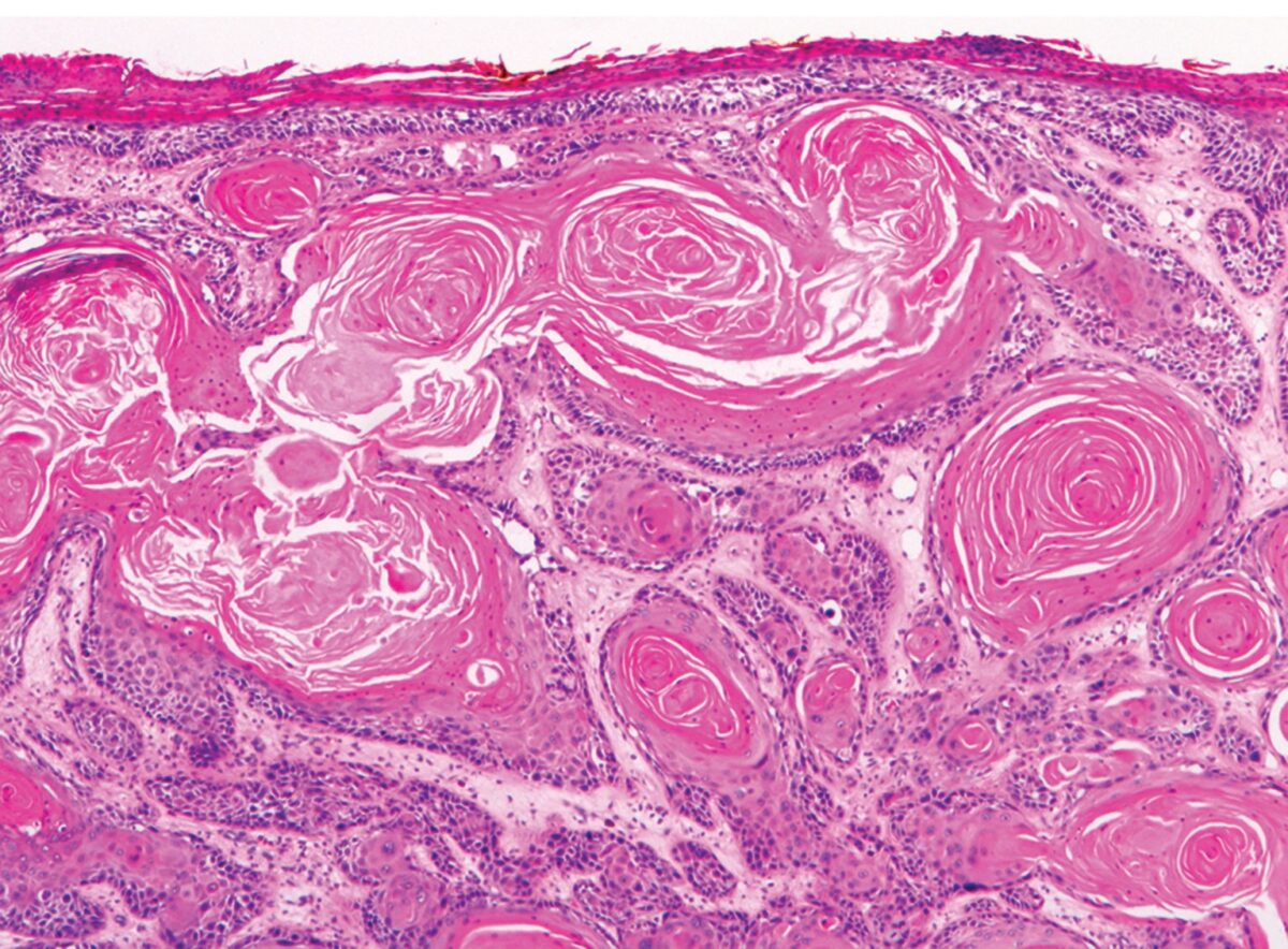 Invasive squamous cell carcinoma (scc)