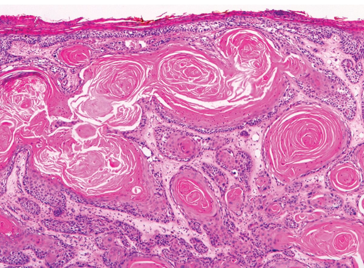 Invasive Squamous Cell Carcinoma Skin Cancer