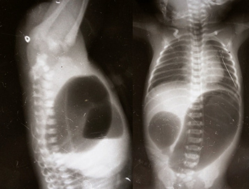Invertograma que muestra una malformación anorectal alta y una vista ap que muestra atresia duodenal