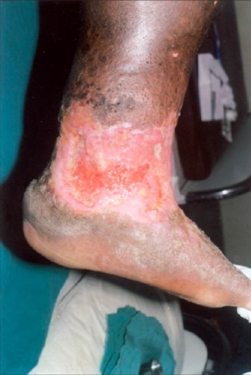 Irregular, nonhealing ulcer on the lower leg and ankle with unhealthy granulation tissue
