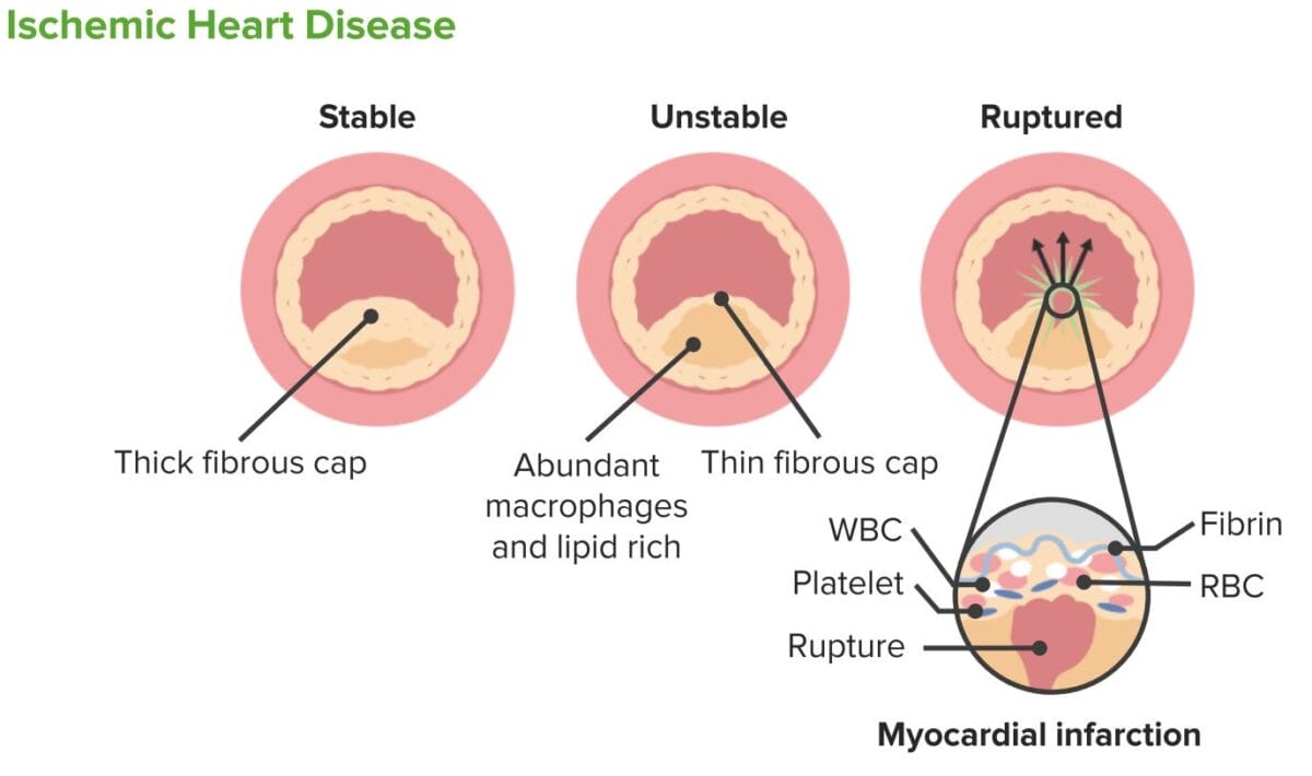 Ischemic heart disease