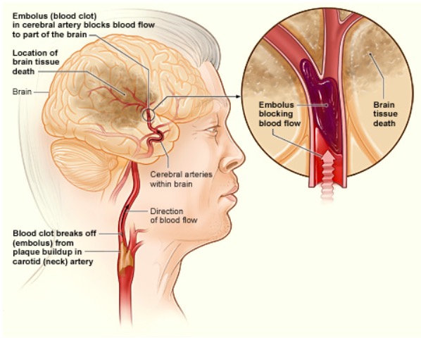 enfermedad-cerebrovascular-isqu-mica-concise-medical-knowledge