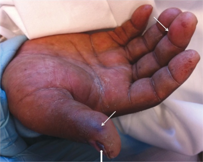 Janeway lesion on palm of a patient