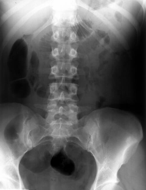 Rins, ureteres, radiografia de bexiga sem anormalidades