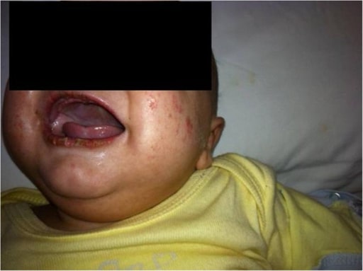 Kawasaki disease 3-month old patient