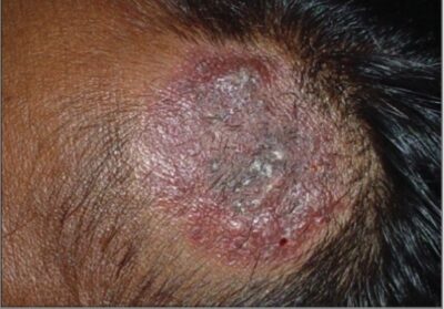 Dermatophytes/Tinea Infections | Concise Medical Knowledge