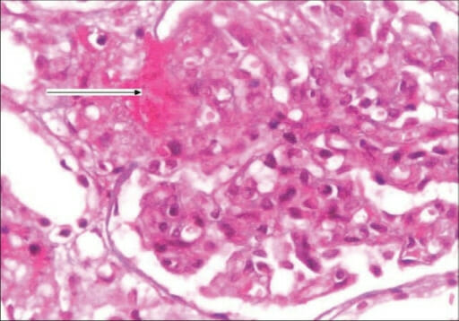 Kidney biopsy of hemolytic uremic syndrome