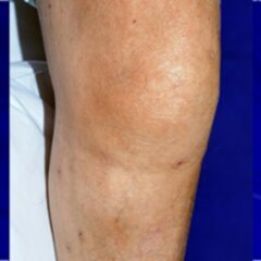 Knee swelling and mild erythema in a patient with septic arthritis