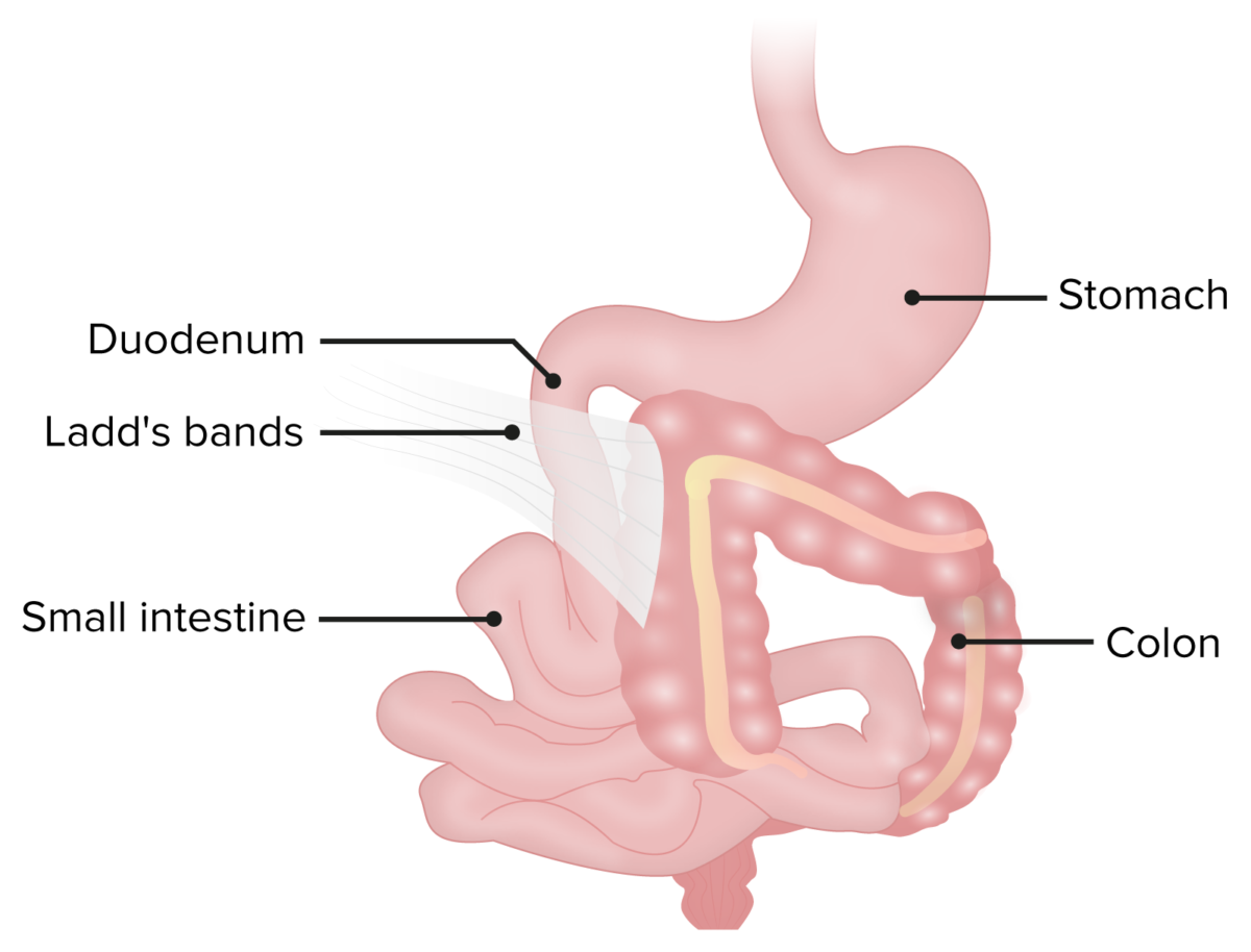 Ladd’s bands in patient with malrotation