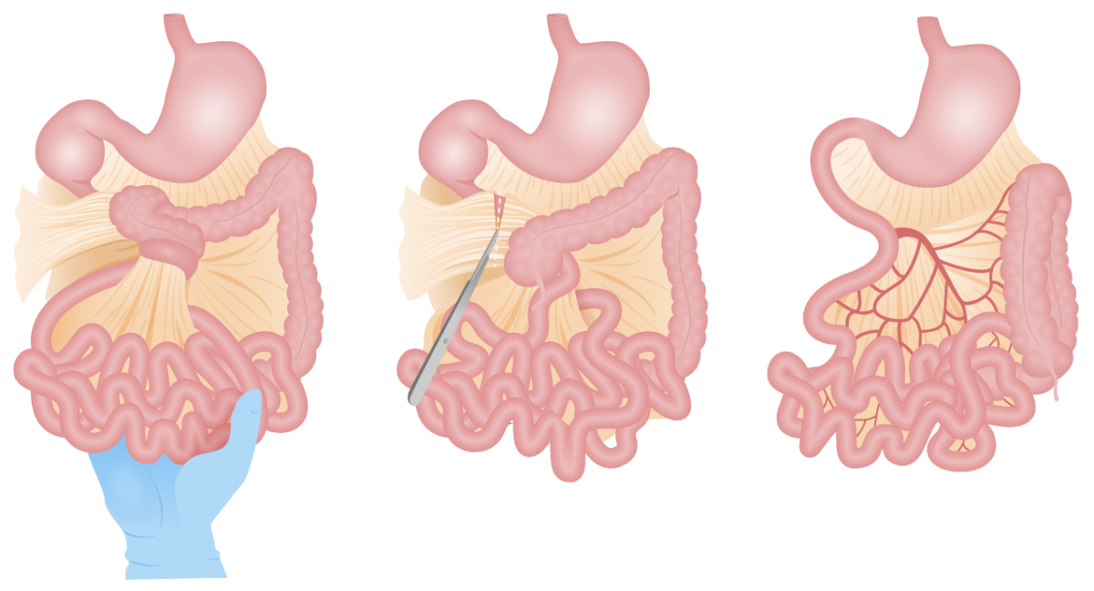 Procedimiento de ladd