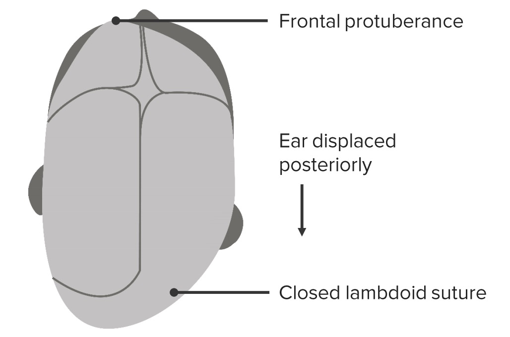 Lambdoidal synostosis