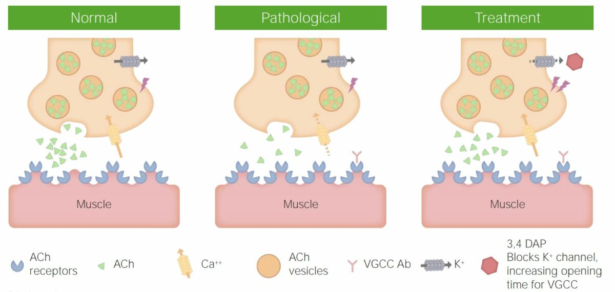 Lambert-eaton myasthenic syndrome pathophysiology