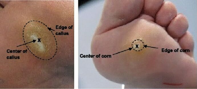 Landmarks of a callus (left) and a corn (right)