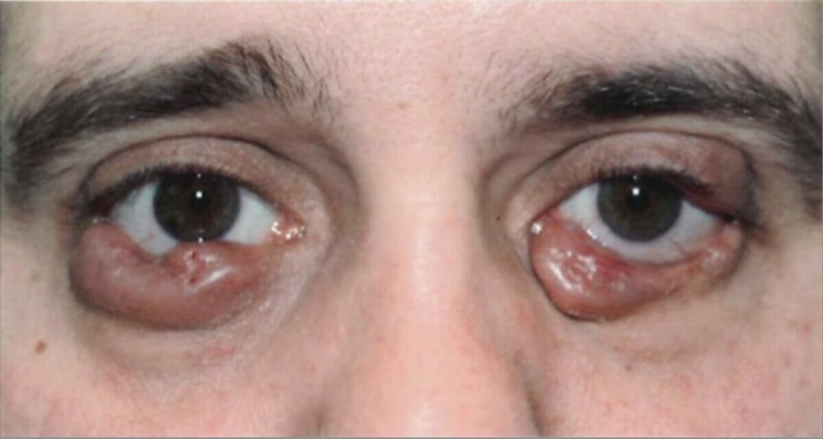 Langerhans cell histiocytosis with bilateral eyelids