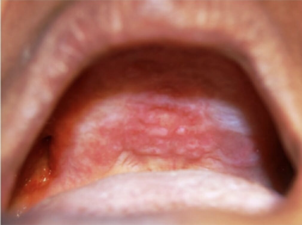 Langerhans cell histiocytosis with oral manifestations