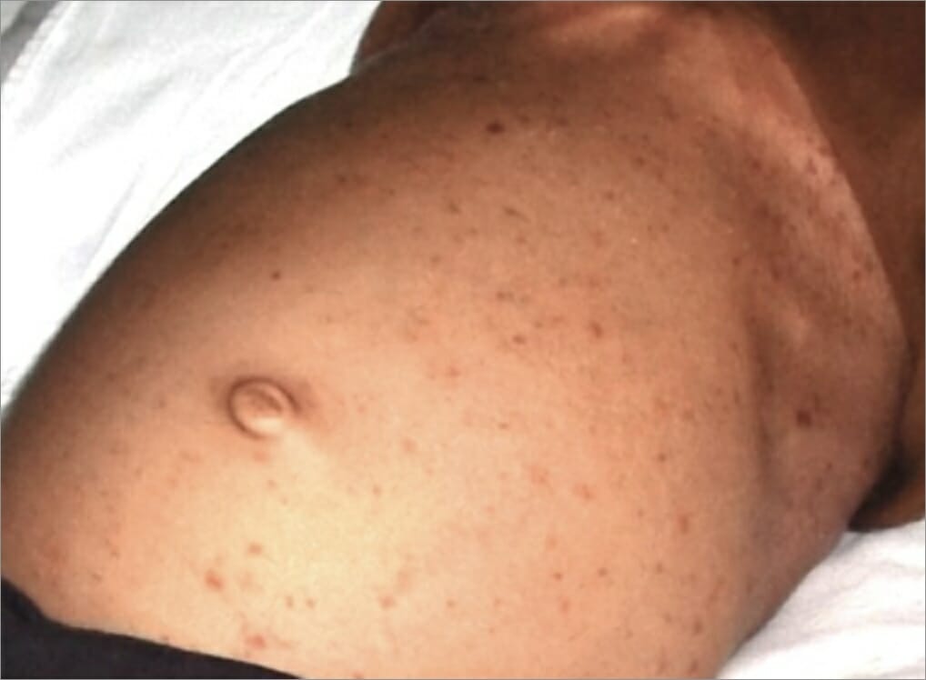 Langerhans presenting with multiple papules with blotting of stomach