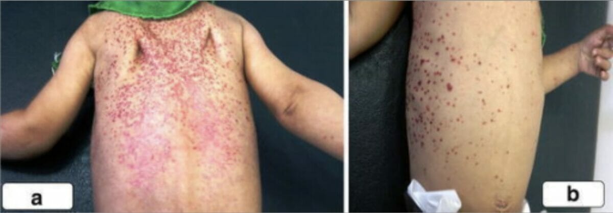 Langerhans presenting with scaly erythematous rash