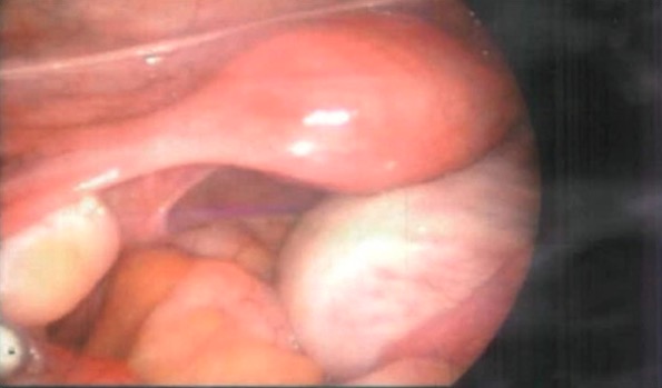 Laparoscopic finding shows an enlarged right ovary