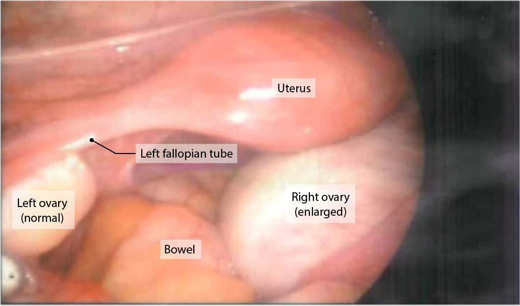 Laparoscopic image showing an enlarged right ovary