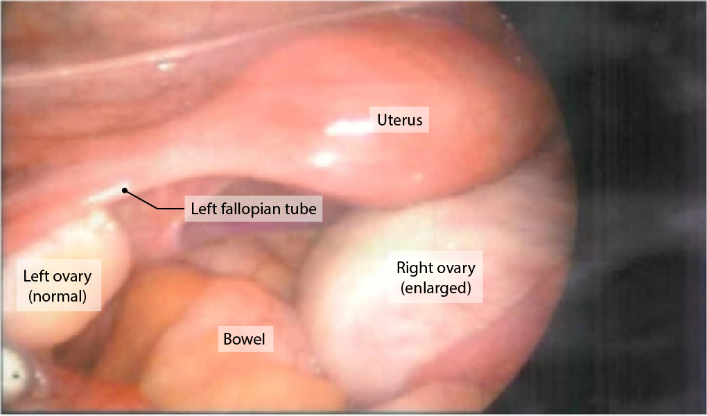 Pain in right ovary then gush of discharge — The Bump