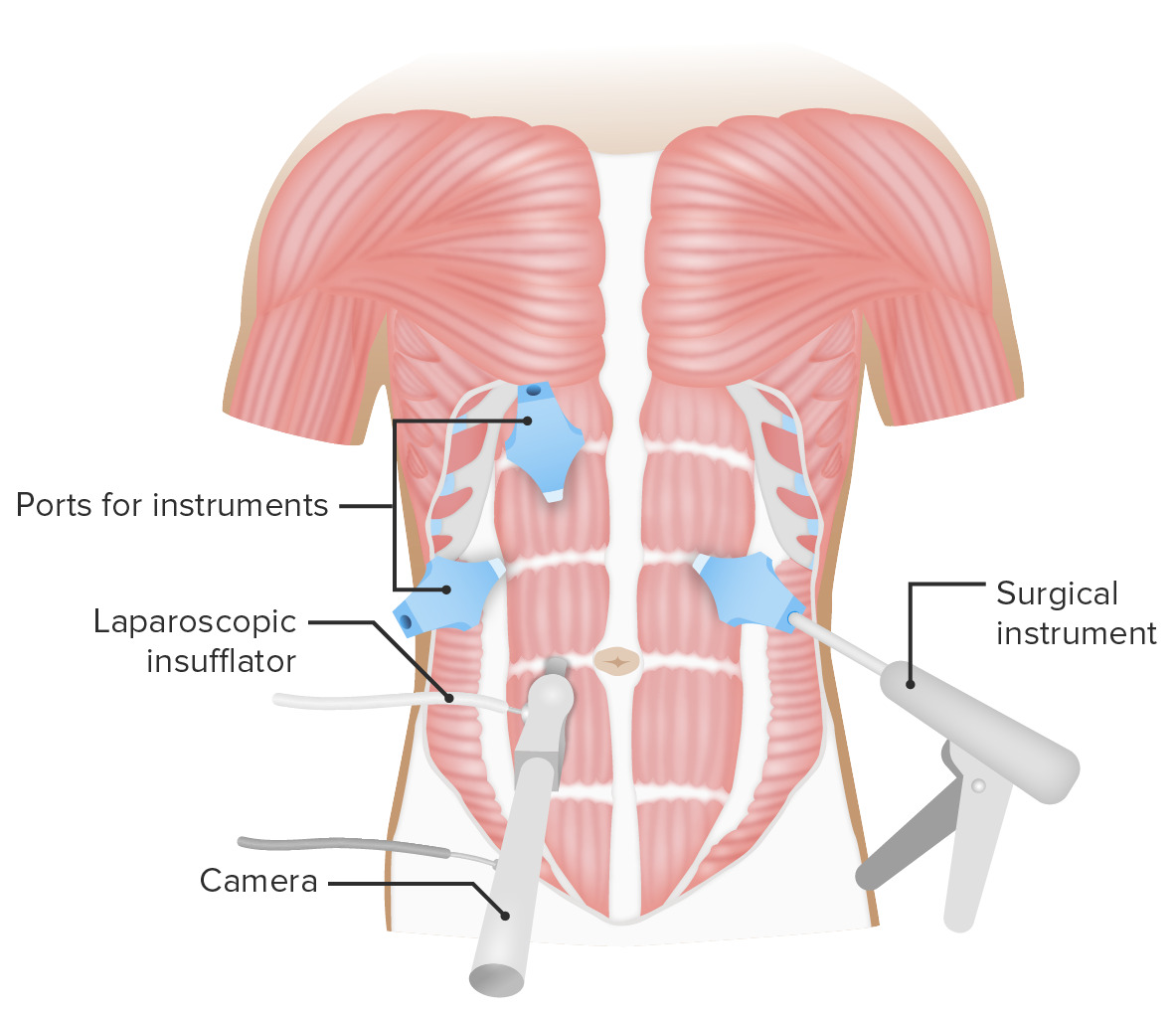 Intervención laparoscópica del abdomen