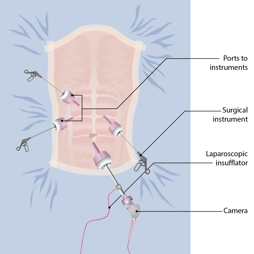 Ooforectomia esquerda laparoscópica com incisão única